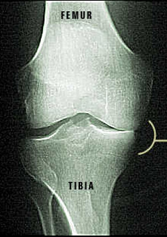 Damaged Knee