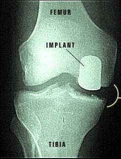 Repaired Knee